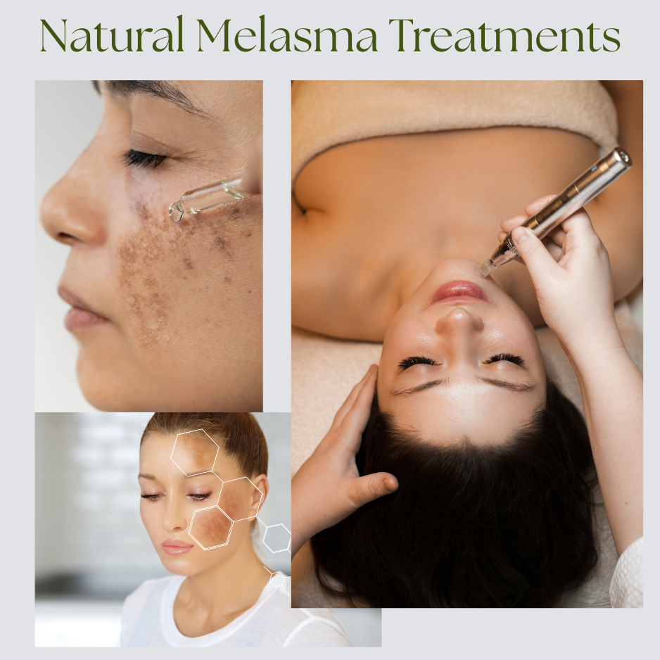 Melasma 101: Why It Happens and How We Treat It Holistically at Natural Care Doc