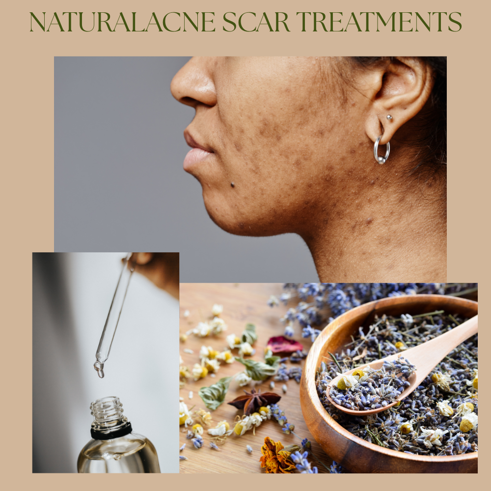 Microneedling for Acne Scars: Collagen Repair, Exosomes & Skin Healing